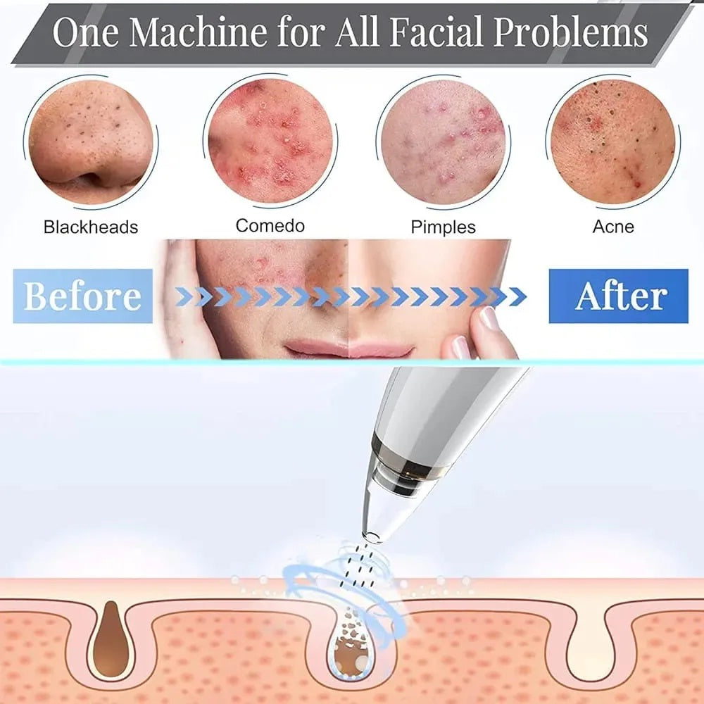 6 in 1 Blackhead Remover USB Rechargeable Derma Suction Blackhead Removal Machine